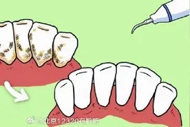 洗牙后牙齿没有变白是怎么回事？图片