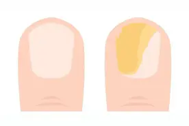 如何对付灰指甲？图片