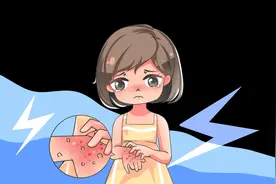 瘙痒如影随形！1300万名慢性荨麻疹该如何回归正常生活图片