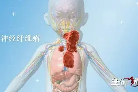 疼痛、畸形、残疾……有这样一群孩子 他们被称为“泡泡宝贝”图片