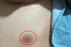 男子手术数月后刀口发炎并发现线头，医院：可能是将可吸收的内缝线排出来了图片
