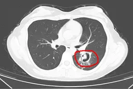 女子高烧40℃，肺部长霉斑！只因干家务时忽视这一细节……图片