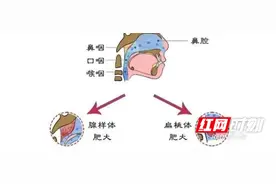 「甘货」儿童扁桃体肥大，要不要手术？图片