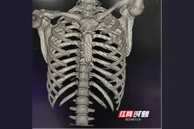 永医科普丨肋骨外伤是否有必要做三维重建图片