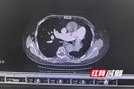 心里不舒服，原来是肺被“栓住”了图片