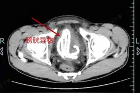 杭州男子膀胱里惊现一条玉制“小蛇”！医生提醒：这些好奇心不可有图片