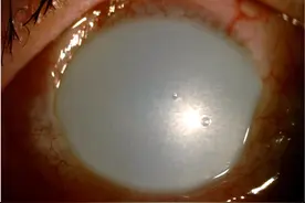 年底大扫除需注意！火碱入眼36岁男子左眼灼伤后白似“珍珠”图片