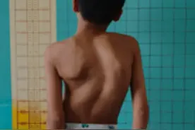 11岁男孩脊柱侧弯120°，扭成了S形！你家孩子脊柱还好吗？图片