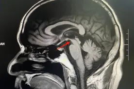 腿疼无力被误诊为脑梗死多年，详查后诊断出罕见的中脑萎缩图片