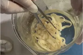 南瓜籽+槟榔，女子排出10米长寄生虫……长期可引起肠穿孔、肠出血等图片