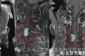 【垂医病例】肢体麻木不能忽视！图片