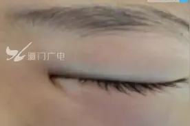 厦门一8岁男孩挖鼻孔导致颅内感染被送入ICU图片