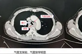 重获新生！“双镜合璧”新技术为复杂食管癌患者带来生命曙光图片