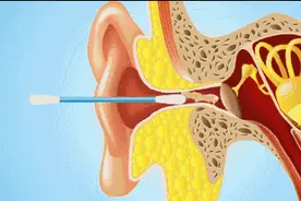 女白领喜欢掏耳朵越掏越痒，过度清洁耳朵或致真菌性外耳道炎图片