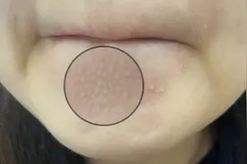 下巴凸起的小颗粒，到底是个啥啊？图片