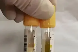 血液像牛奶！福州张女士被送医抢救！只因爱吃……图片