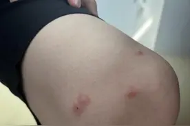 女孩腿上长带水疱红疹涂花露水无效，医生：是虫咬皮炎，可涂抹炉甘石洗剂图片