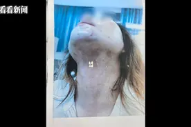 噩梦！上海一女子屡遭家暴！被打断肋骨、划伤胸部……图片