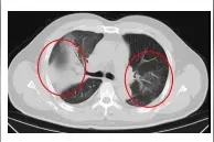 警惕！发现一例罕见传染病“Q热”图片