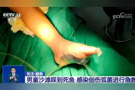 6岁男童踩到死鱼险截肢！“海洋无声杀手”创伤弧菌有多可怕？图片