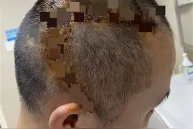 务工青年不慎摔倒致头部受伤，江夏医生成功施行“自体颅骨回植术”图片