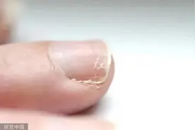 手指倒刺，是缺维生素吗？怎样解决？图片