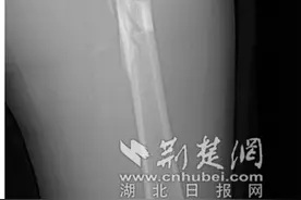 踢球时扭了一下，大腿居然骨折了？医生提醒：运动前做好热身很重要！图片
