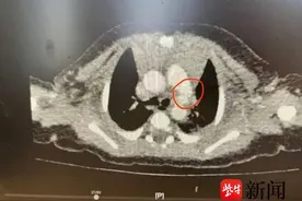 刚出生就做了心脏手术，常州首例新生儿重度肺动脉瓣狭窄球囊扩张手术小患者昨日出院图片