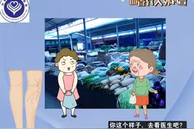 科普小知识|什么是静脉曲张？图片