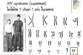 班里有“超雄综合征”小孩怎么办？医生：“超雄”不是恶魔，有的一辈子没有任何异常表征图片