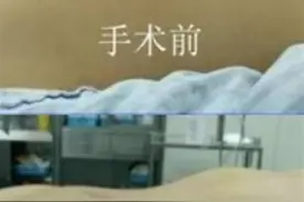 超微创“无痕”手术！十堰人医妇科单孔腹腔镜手术让健康美丽两不误图片