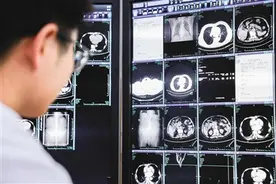 一次平扫CT 筛查多种癌症图片