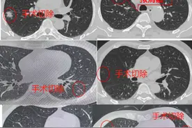 西部地区首例“杂交”手术！看华西医院如何一次性解决多发肺结节！图片