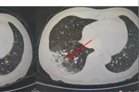 患者反复高烧咳嗽 竟因家里养了一只鹦鹉图片