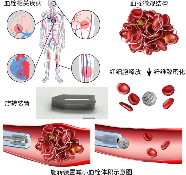 就像搓棉球，这种机器人能进血管把血栓“搓”小95%