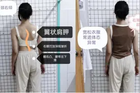 孩子右背鼓起小山包，一查脊柱竟歪成“麻花”图片