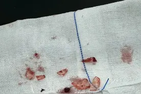 突然爆炸！8岁男童全脸30处伤口图片