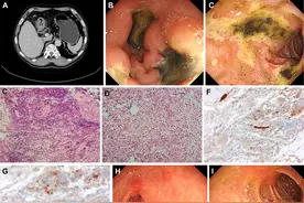 警惕！腹痛黑便背后的罕见“元凶”｜病例学习图片