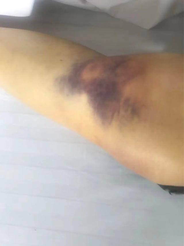 陕西一医院施工不合格，监理白天要求拆除整改	，当晚被打断4根肋骨，“工区突然断电，被3人打晕”	，警方刑事立案