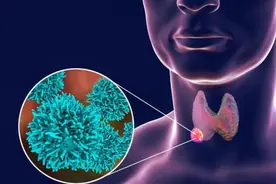 一家三口同患甲状腺癌，手术医生有话要说图片