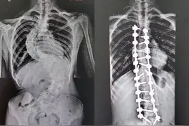 湖南16岁女孩脊柱侧弯获矫正 暑期蜕变身高增六厘米图片