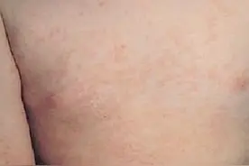 高烧不退！郑州已有多名孩子确诊，医生重要提醒→图片