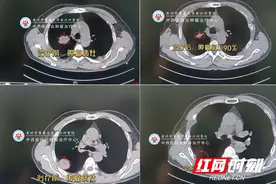 M6射波刀精准治疗 肺小细胞癌患者重获新生图片