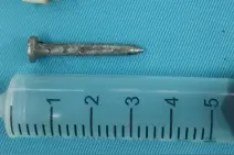 3厘米气枪钢钉射进男子头部，医生团队紧急取钉保住大脑功能图片