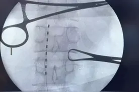 自贡首例脊髓电刺激植入术成功实施 助力颅脑损伤患者康复图片