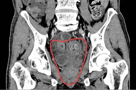 山东第一医科大学附属中心医院东院胃肠外科联合泌尿外科连续开展3例全盆腔脏器切除术图片