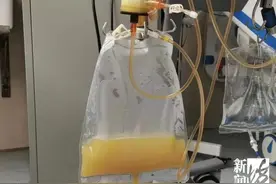 堪称“油王”！男子突发剧烈腹痛，抽血抽出一袋油……罪魁祸首竟是它图片