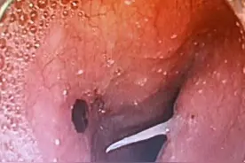 女士误吞一根大鱼刺，鱼刺快速逼近胸主动脉……图片