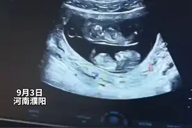 孕妈晒肚中双胞胎的B超录像，俩小家伙还是 “上下铺”，“觉得很幸福很开心”图片
