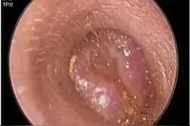 喜欢随手就挖，男子经常掏耳朵诱发外耳道癌图片